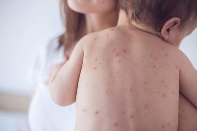 Perda de status de pas livre de sarampo  retrocesso, diz pediatra