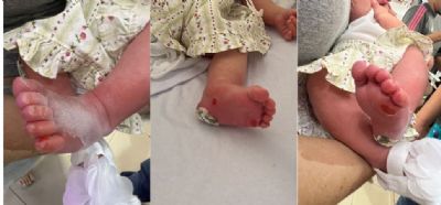 Fotos | Me acusa laboratrio de causar ferimento em pezinho de recm-nascida durante teste