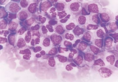 Anvisa autoriza pesquisa em pacientes com leucemia linfoide aguda B