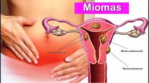 Mioma  segunda maior causa de cirurgia em mulheres