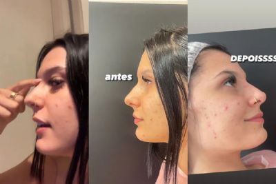 Ana Castela mostra resultado de procedimento esttico no nariz