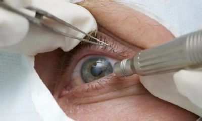Mdicos alertam para riscos de cirurgia de mudana da cor dos olhos