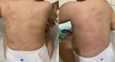 Me denuncia creche de Cuiab aps beb de 1 ano aparecer com hematomas nas costas