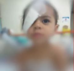 Menina de 2 anos que grudou plpebras com cola no DF passa por cirurgia