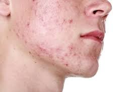 Controle de acnes na adolescncia pode ser feito com alimentao saudvel