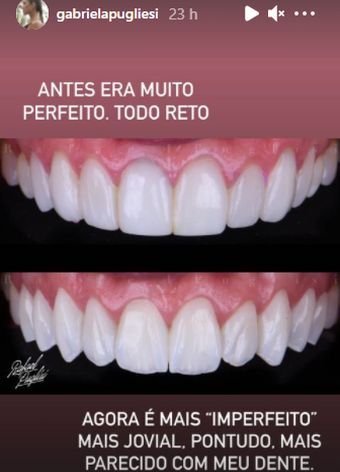Gabriela Pugliesi passa por procedimento para deixar os dentes imperfeitos