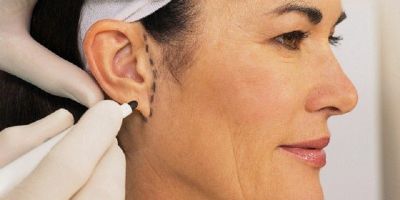Otoplastia: cirurgia plstica  alternativa para pessoas com orelhas proeminentes