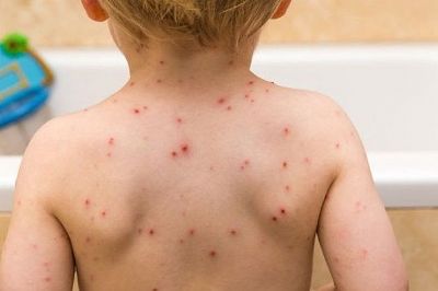 Caso de sarampo em criana de MT acende alerta e mdico recomenda vacinao