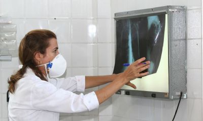 Tratamento mais eficiente no SUS beneficia pacientes com tuberculose
