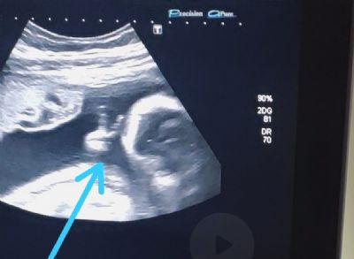 Beb faz 'V de vitria' em ultrassom, e pai com cncer raro comemora